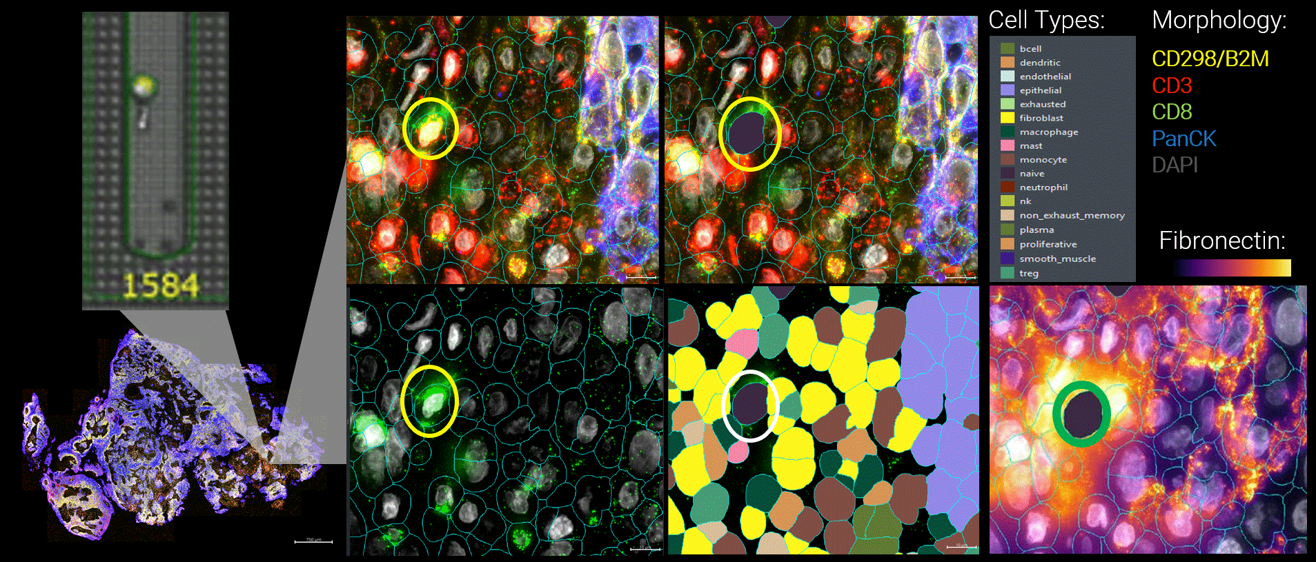 By integrating live functional and spatial data, a more nuanced picture of the tumor microenvironment emerges. Here, functional tumor-infiltrating lymphocytes identified by the Beacon were observed infiltrating malignant tumors. Yet despite their functional capacity, these cells were embedded within a suppressive local environment. Regulatory T cells were enriched nearby, and fibronectin encapsulation formed a physical and biochemical barrier around the functional T cell, effectively isolating it within the tumor.