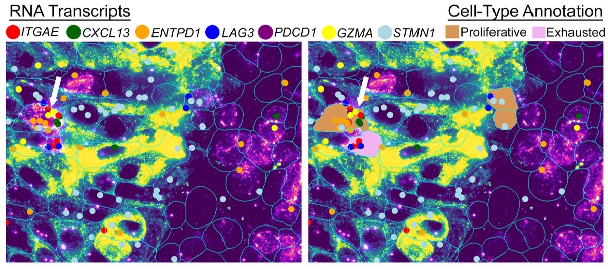 WTX analysis on the CosMx platform reveals the spatial presence of proliferative tumor-reactive T cells alongside exhausted T cell populations within the tumor microenvironment, enabling identification of distinct gene expressions associated with functional state.